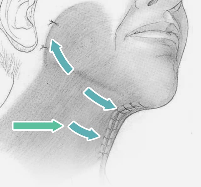 Neck Lift Diagram