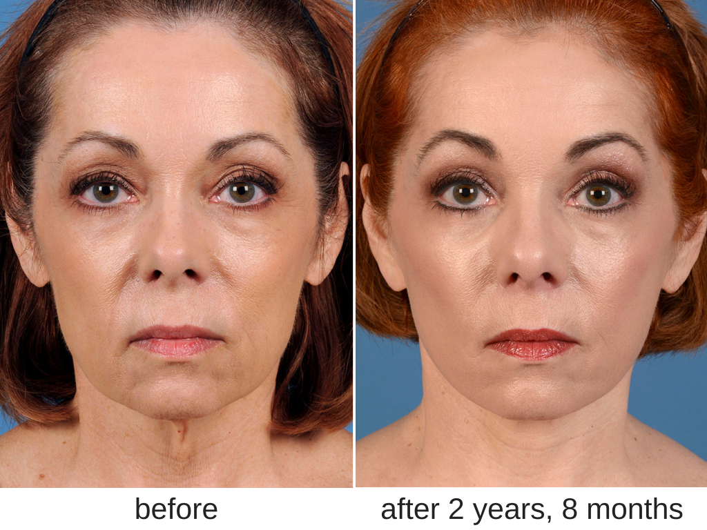 Before and after a facelift in Dallas.