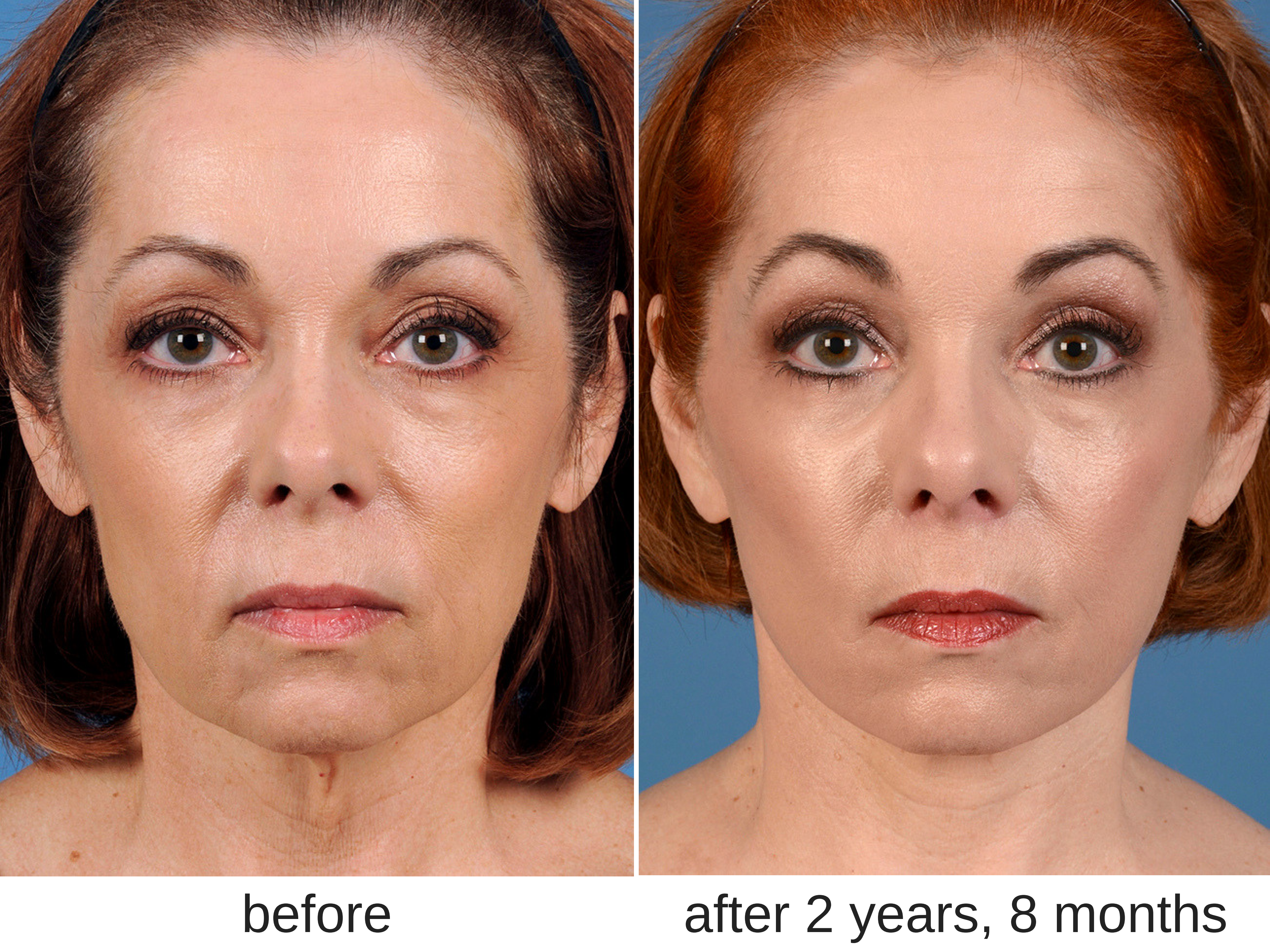 Facelift before and after