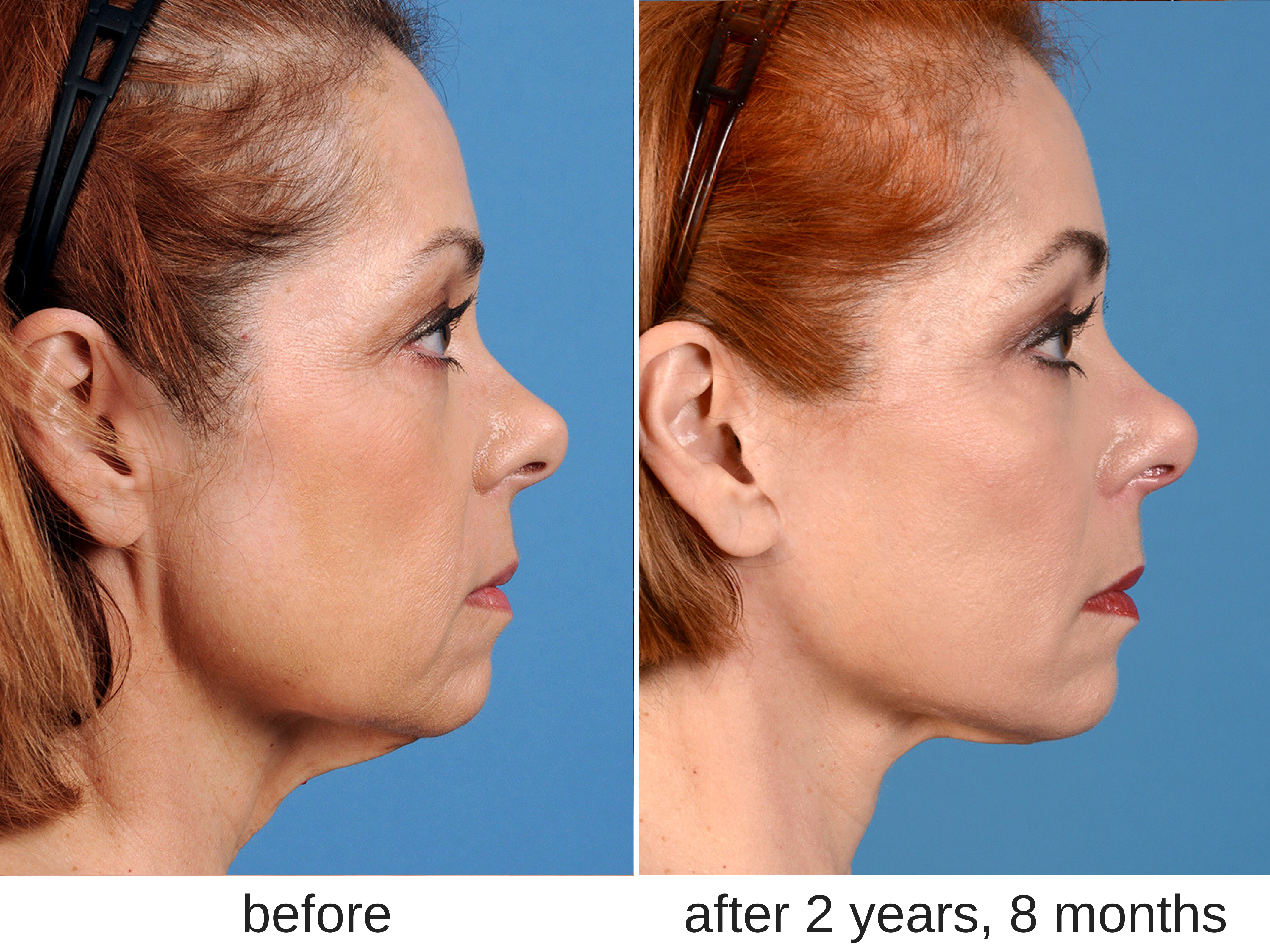 Facelift before and after