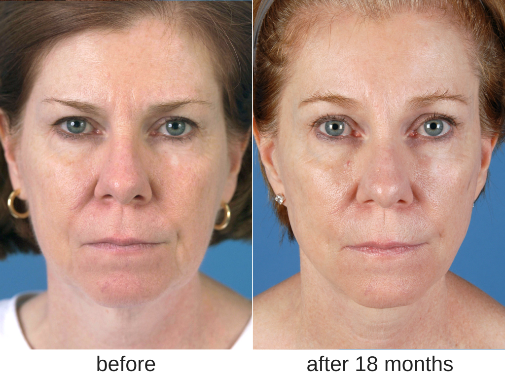 Before and after facelift in Dallas, TX.