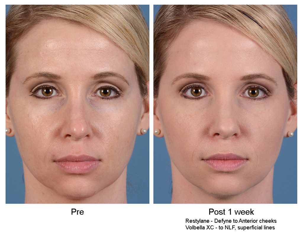 Restylane and Volbella image 