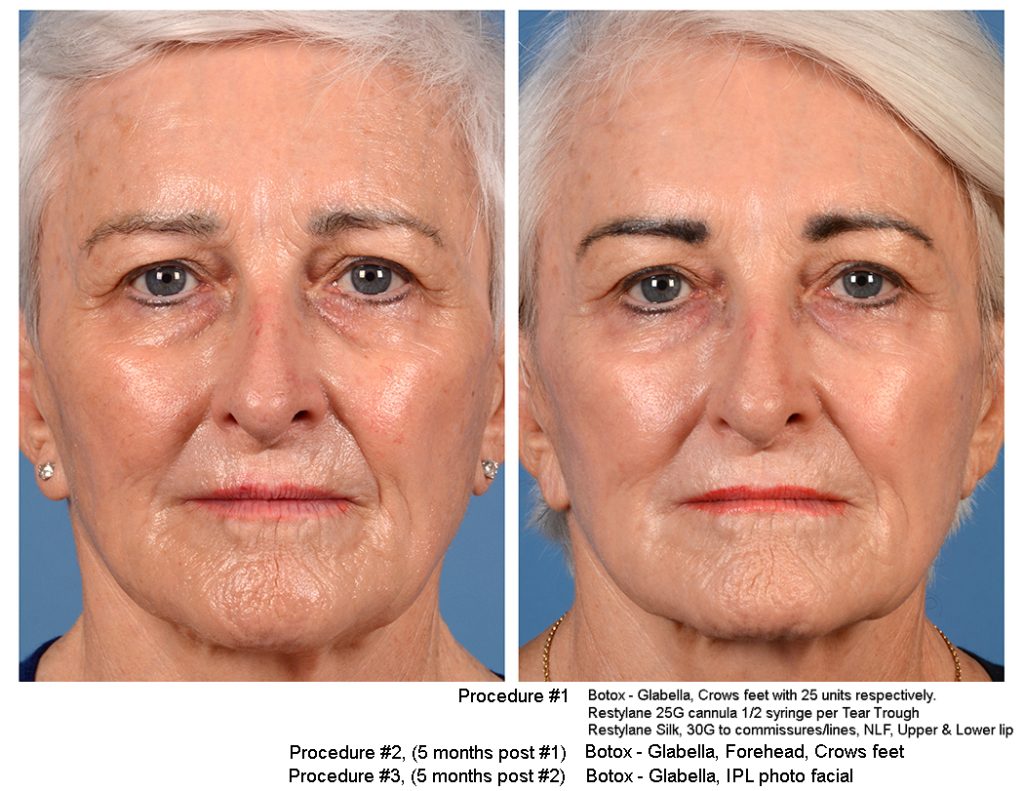 Facial injections image