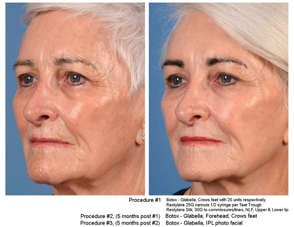 Before and after facial injections.