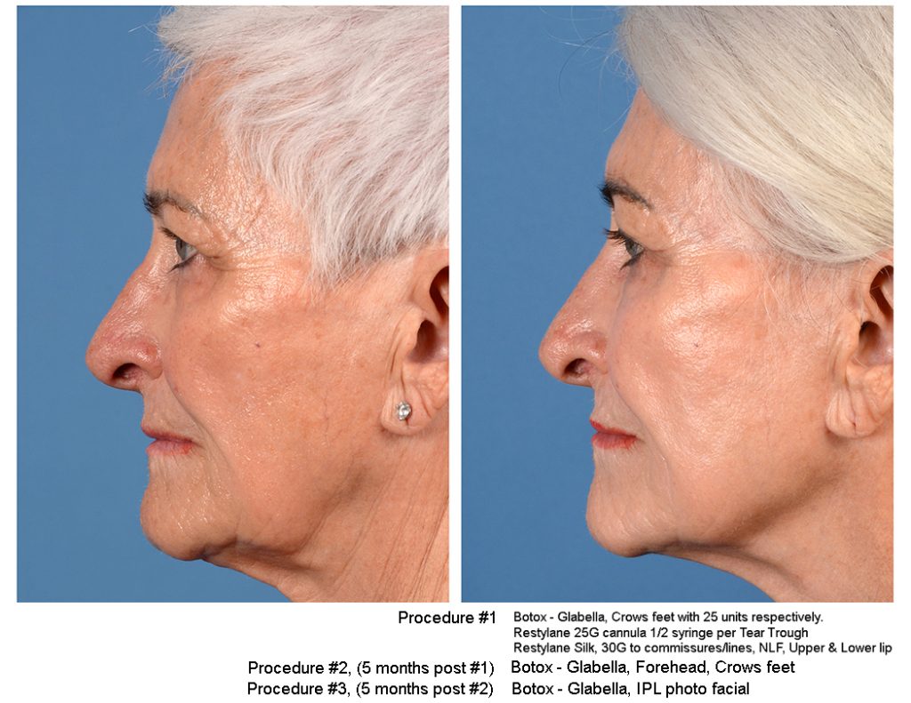 Facial fillers before and after image. 