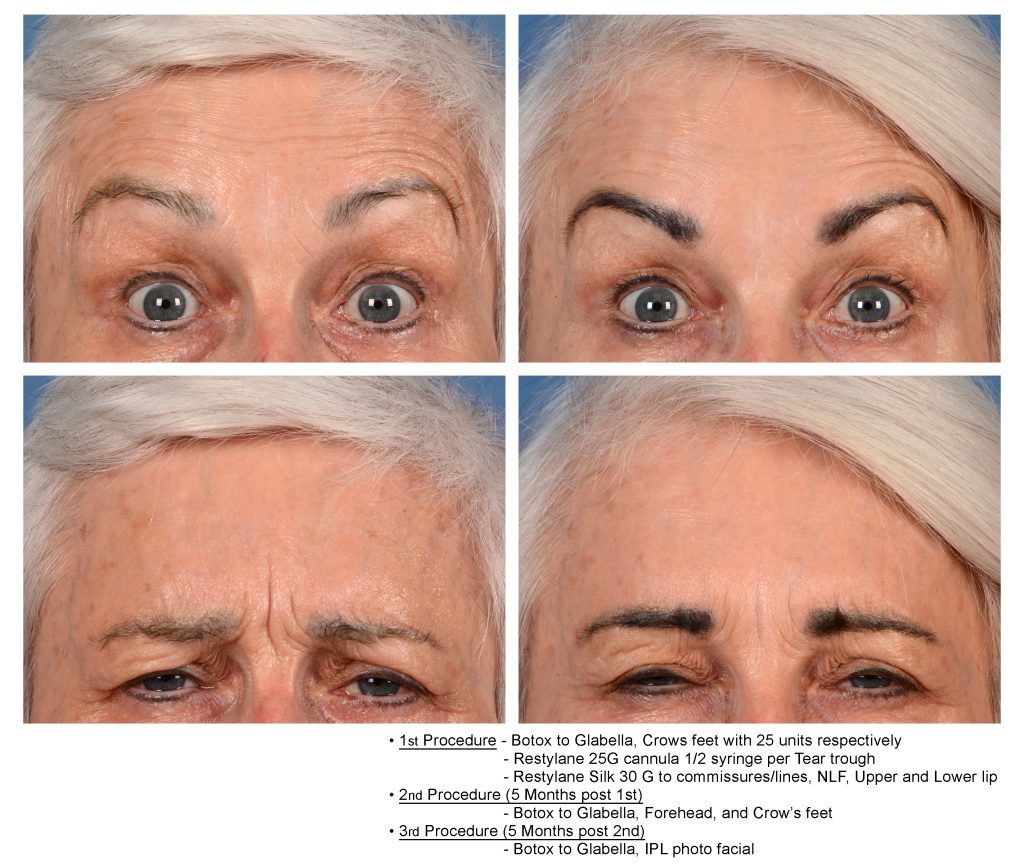Botox forehead injections image.