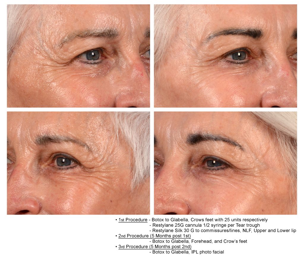 Crows feet before and after Botox image