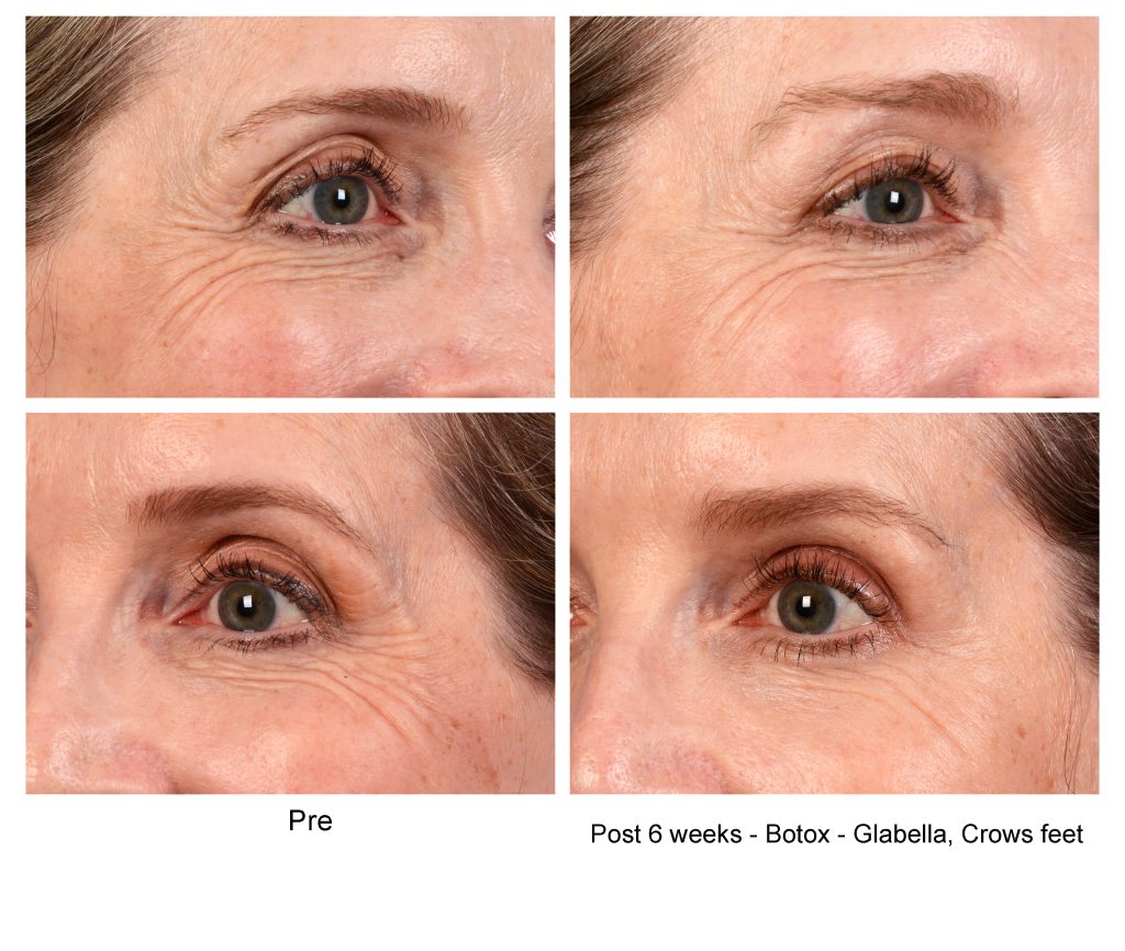 Botox injections image in Frisco, TX.