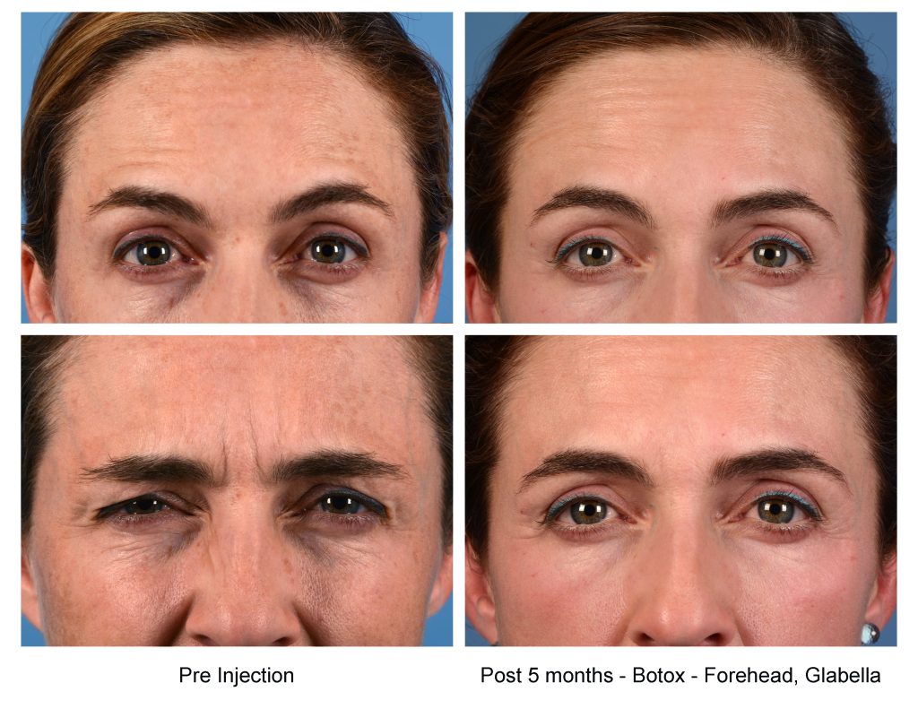 "ttps://www.drkenkel.com/photo-gallery/nonsurgical-procedures/injectables"