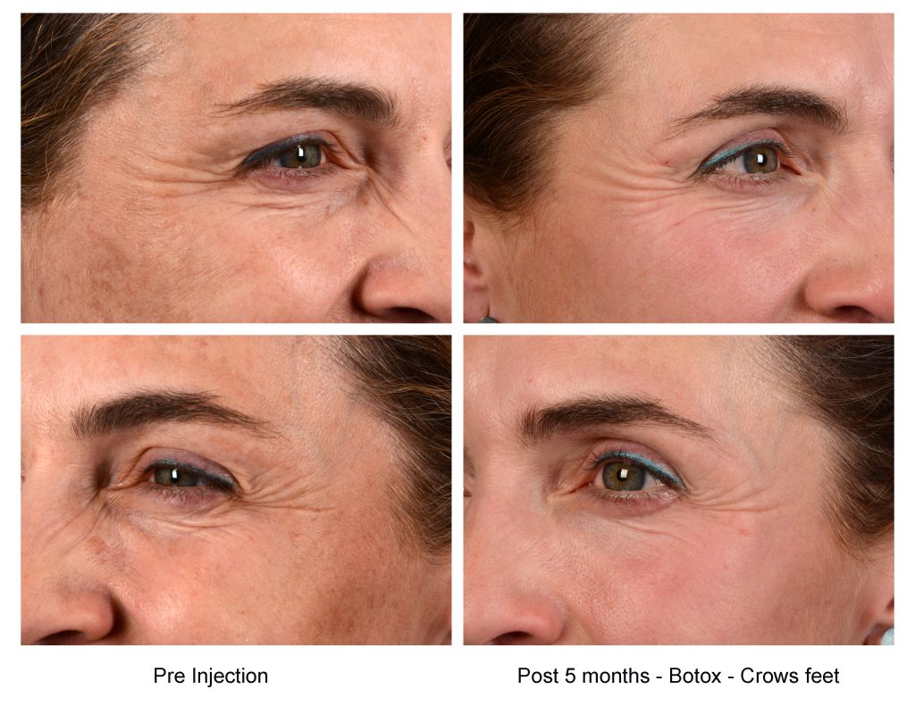 Botox injections image Dallas.