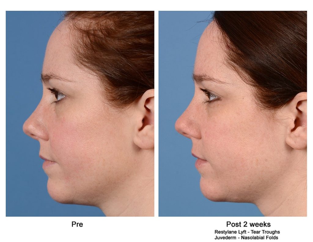 Before and after filler treatment image