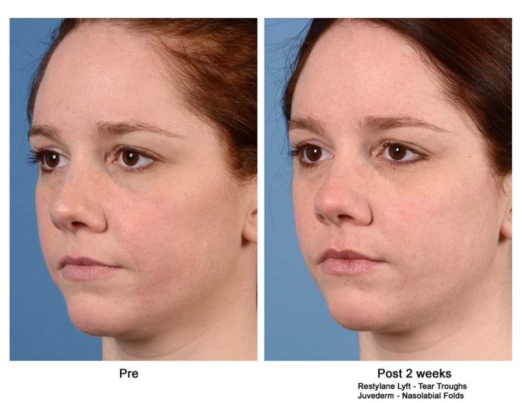 Filler treatment image. 