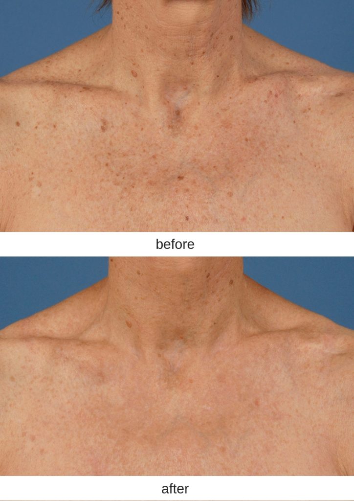 Before and after photos of a Dallas IPL patient's chest.