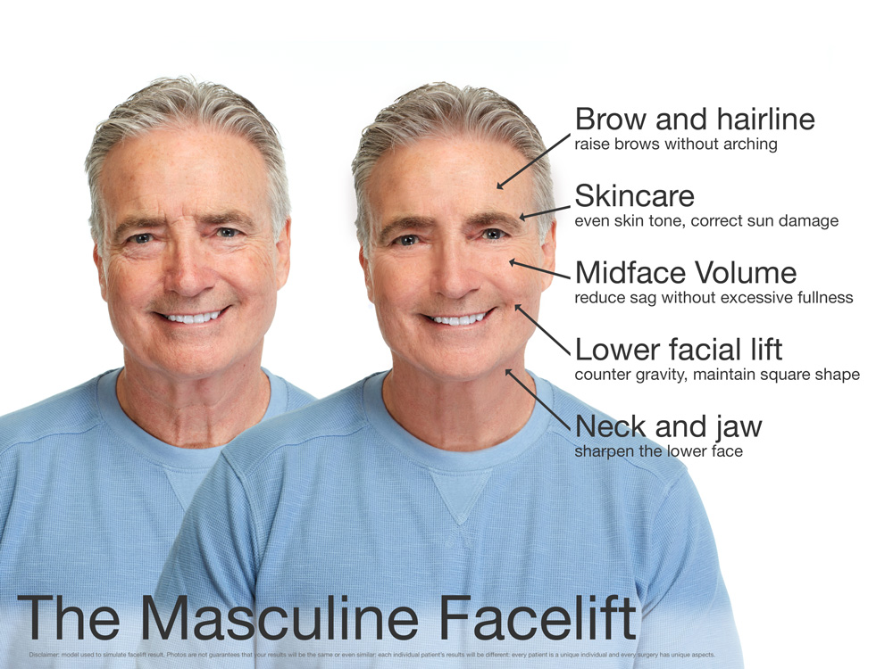 Example of a Male Facelift
