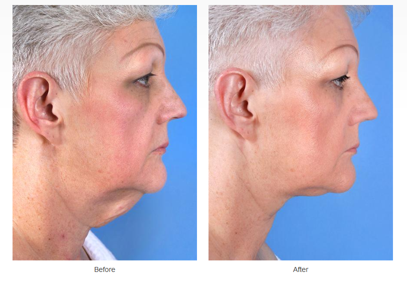 Neck Lift Case #170