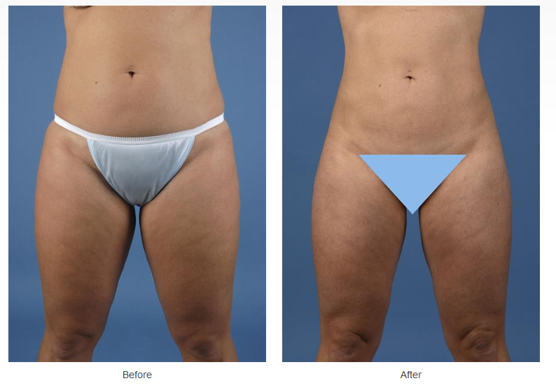 Coolsculpting Case #94