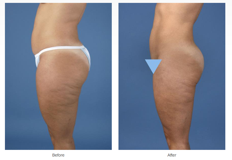 Coolsculpting Case #94