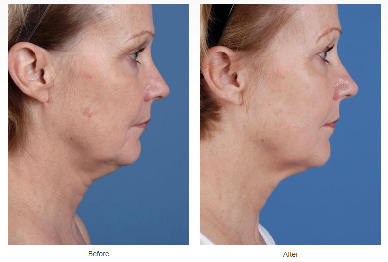 Skin Tightening Case #23