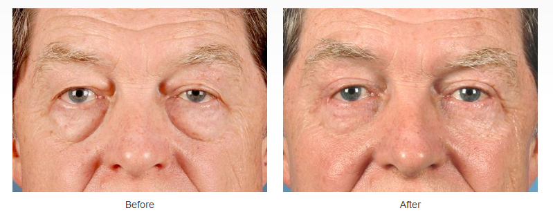 Eyelid Surgery Case 268