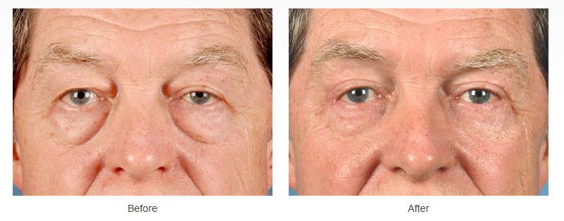 Upper and lower eyelid surgery before and after