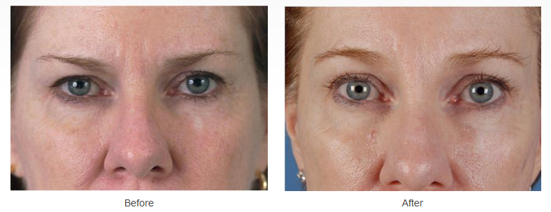 Eyelid Surgery Case 28