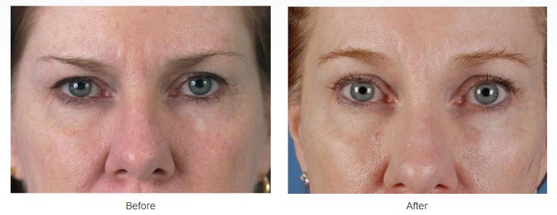 Upper and lower eyelid surgery before and after