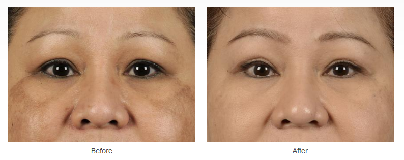 Upper eyelid surgery before and after