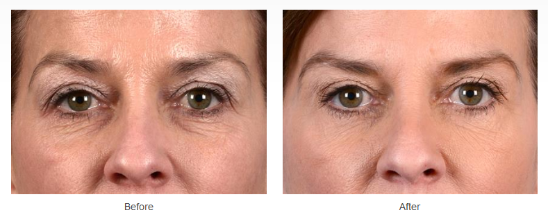 Upper and lower eyelid surgery before and after