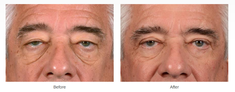 eyelid surgery before and after
