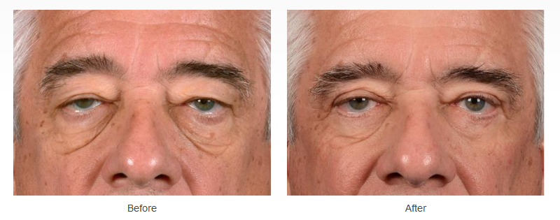 Upper and lower eyelid surgery before and after