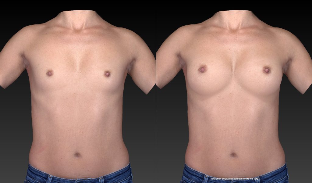 3 D Imaging Vectra (Before and After) Real Patient of Dr. Kenkel