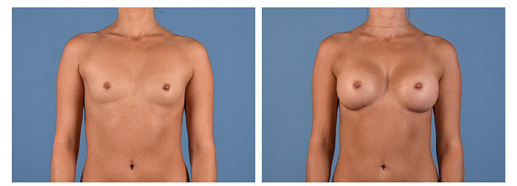 Same Real Patient of Dr. Kenkel (Before and After) 6 months post- op
