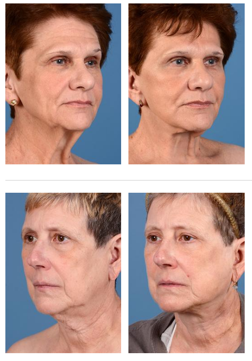 Real Patients - Facelift Cases 263 and 264