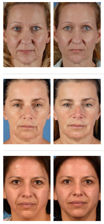 Before and After Botulinum Toxin Injections, Real Patient Cases 190, 77, and 75