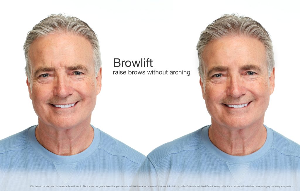 male browlift simulation before and after