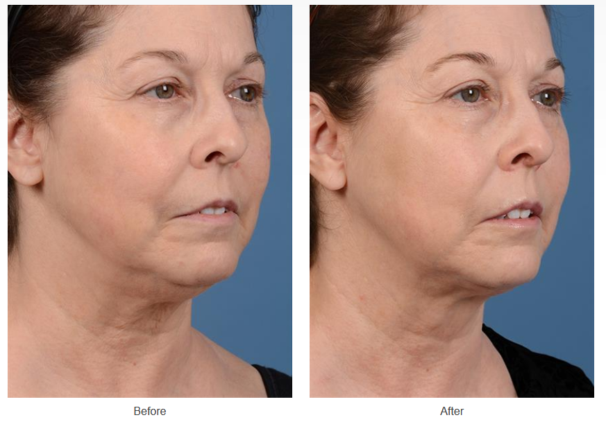 Before and after neck liposuction on a female patient