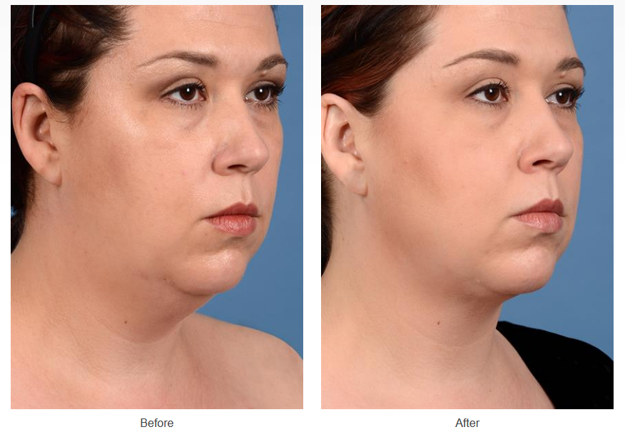 Before and after neck liposuction on a female patient