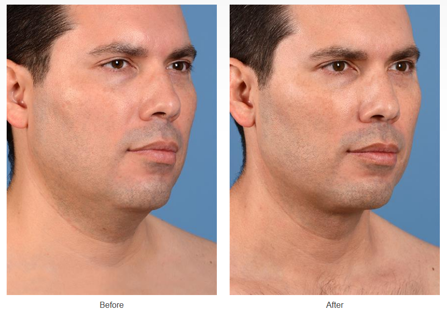 Before and after neck liposuction on a male patient