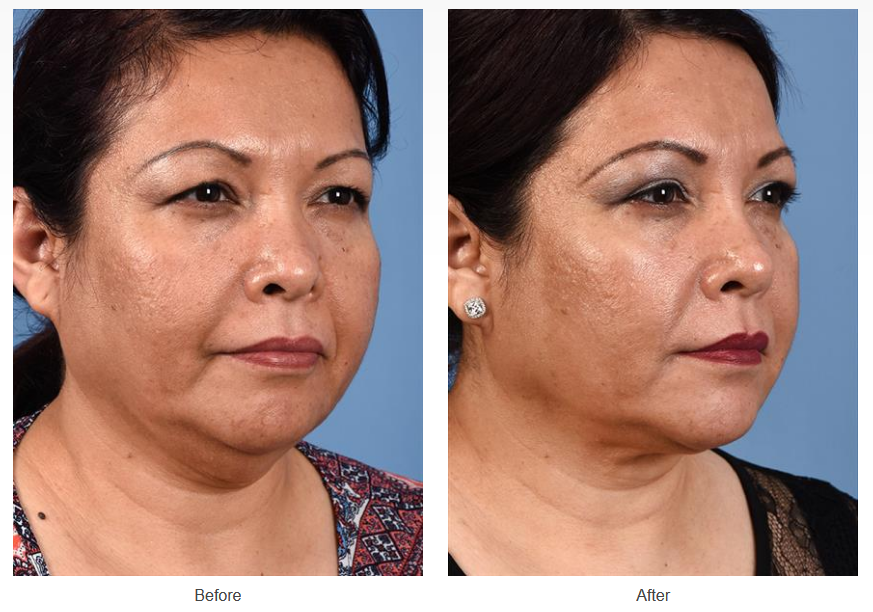 Before and after neck liposuction on a female patient