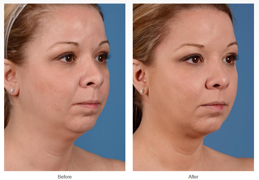 Before and after neck liposuction on a female patient