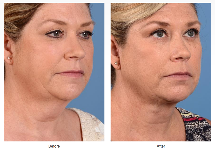 Before and after neck liposuction on a female patient