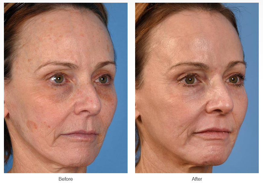 Before and After Photos of Laser Treatments Case #313
