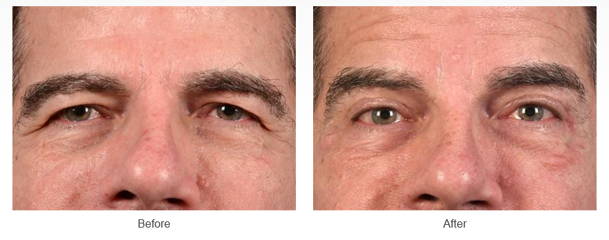 Upper eyelid surgery before and after