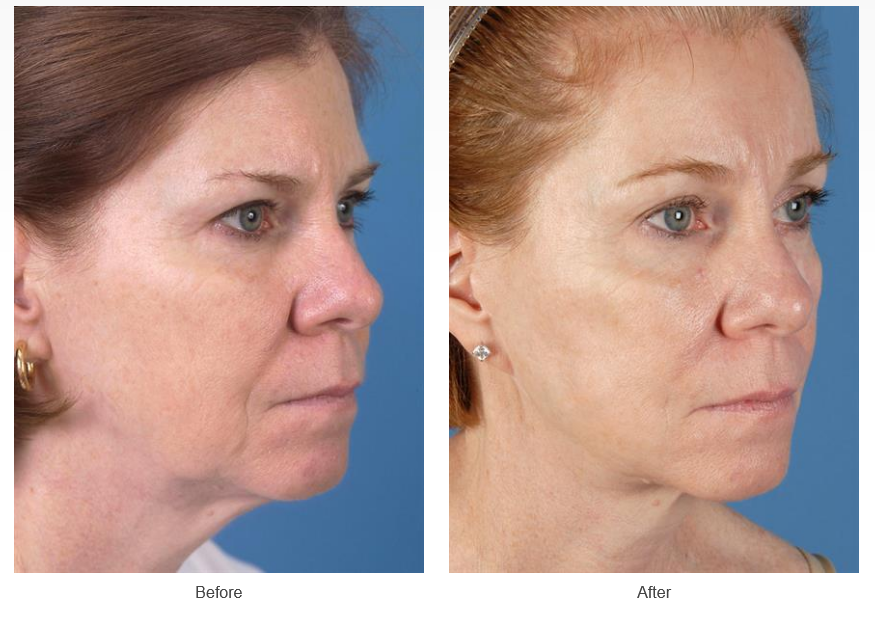 Before and After Facelifts. All healing stages and tips for a quick  recovery — Kassir Plastic Surgery in NY and NJ