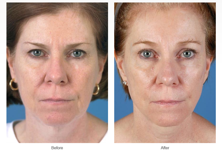 Facelift before and after