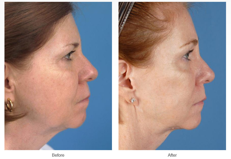 Facelift before and after