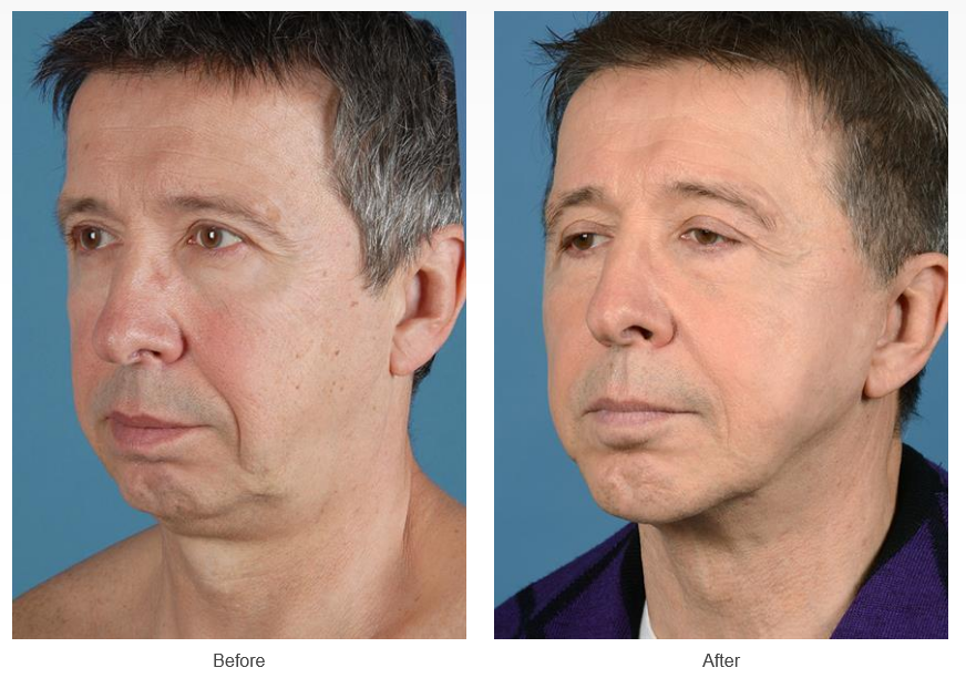 Facelift before and after