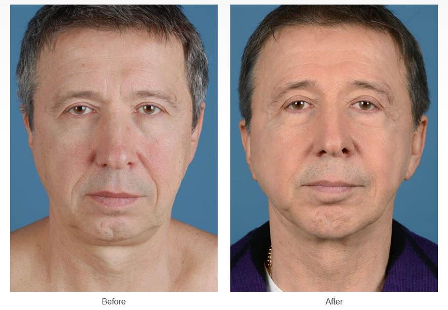 Facelift before and after