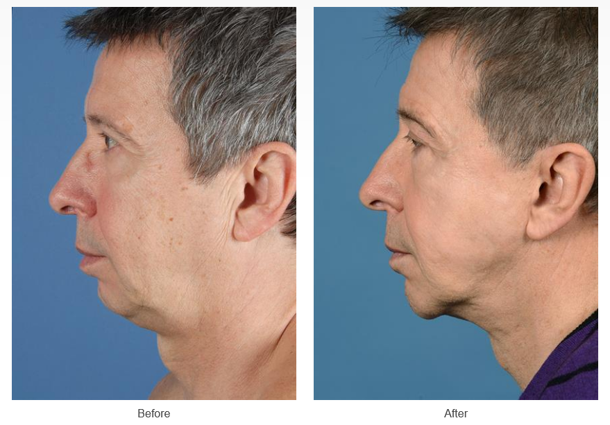 Facelift before and after