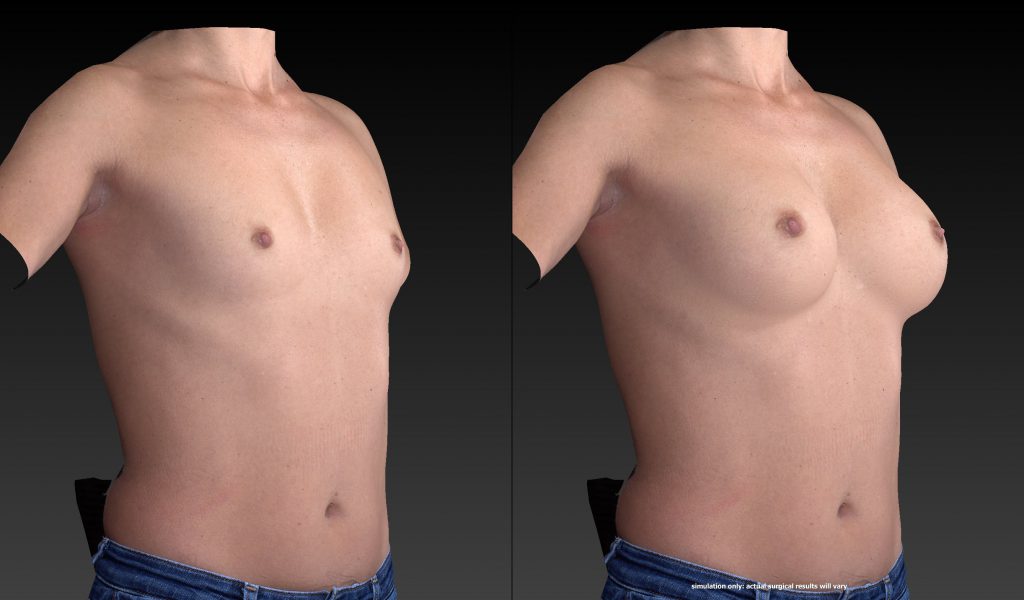 3 D Imaging Vectra (Before and After) Real Patient of Dr. Kenkel